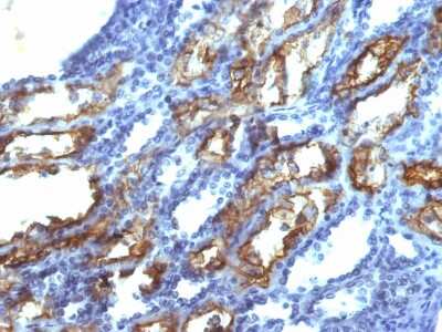 Immunohistochemistry-Paraffin: IFN-gamma Antibody (IFNG/466) - Azide and BSA Free [NBP2-54394] - Formalin-fixed, paraffin-embedded human Renal Cell Carcinoma stained with IFN-gamma Mouse Monoclonal Antibody (IFNG/466).