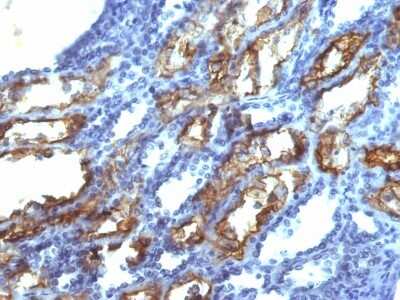 Immunohistochemistry-Paraffin: IFN-gamma Antibody (IFNG/466) [NBP2-53332] - Formalin-fixed, paraffin-embedded human Renal Cell Carcinoma stained with Interferon gamma Monoclonal Antibody (IFNG/466)