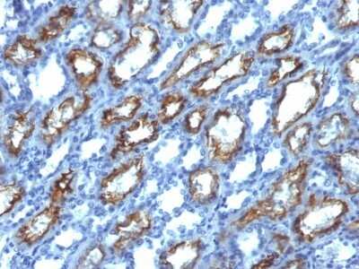 Immunohistochemistry-Paraffin: IFN-gamma Antibody (IFNG/466) [NBP2-53332] - Formalin-fixed, paraffin-embedded human Renal Cell Carcinoma stained with Interferon gamma Monoclonal Antibody (IFNG/466)