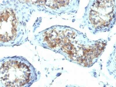 Immunohistochemistry-Paraffin: IFN-gamma Antibody (IFNG/466) [NBP2-53332] - Formalin-fixed, paraffin-embedded human Testicular Carcinoma stained with Interferon gamma Monoclonal Antibody (IFNG/466)