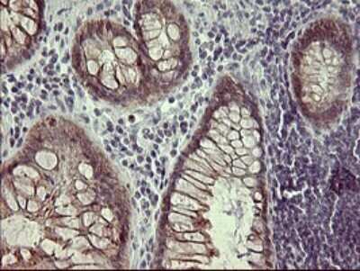 Immunohistochemistry: IFN-gamma R2 Antibody (OTI1C2) - Azide and BSA Free [NBP2-71008] - Analysis of Adenocarcinoma of Human colon tissue.