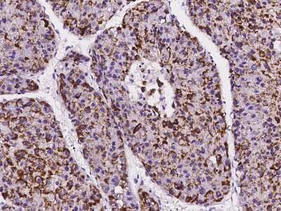 Immunohistochemistry-Paraffin: IFT20 Antibody [NBP2-99594] - Immunochemical staining of human IFT20 in human hepatoma with rabbit polyclonal antibody at 1:1000 dilution, formalin-fixed paraffin embedded sections.