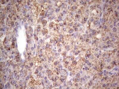 Immunohistochemistry: IGF-I Antibody (4B12) [NBP2-46037] - Analysis of Carcinoma of Human liver tissue.(Heat-induced epitope retrieval by 1 mM EDTA in 10mM Tris, pH8.5, 120C for 3min)