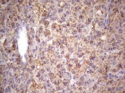 Immunohistochemistry: IGF-I/IGF-1 Antibody (OTI4B12) - Azide and BSA Free [NBP2-71010] - Analysis of Carcinoma of Human liver tissue.(Heat-induced epitope retrieval by 1 mM EDTA in 10mM Tris, pH8.5, 120C for 3min)