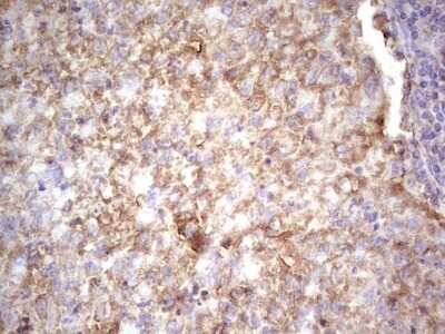 Immunohistochemistry: IGF-I/IGF-1 Antibody (OTI4B12) - Azide and BSA Free [NBP2-71010] - Analysis of Carcinoma of Human lung tissue.(Heat-induced epitope retrieval by 1 mM EDTA in 10mM Tris, pH8.5, 120C for 3min)