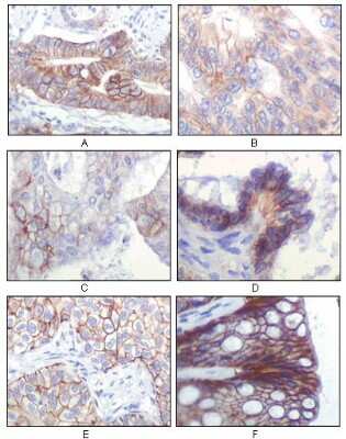 Immunohistochemistry-Paraffin: IGF-I R Antibody (3C8B1) [NBP1-51536] - Human gastric adenocarcinoma(A), colon adenocarcinoma(B), endometrial carcinoma(uterus)(C), ovary adenocarcinoma(D), lung squamous cell carcinoma(E), stomach epithelium mucosae(F), showing localization using IGF-I R with DAB staining.