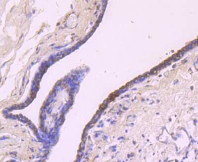 Immunohistochemistry-Paraffin: IGF-II/IGF2 Antibody (JJ092-3) [NBP2-67915] - Analysis of paraffin-embedded human breast carcinoma tissue using anti-IGF2 antibody. Counter stained with hematoxylin.