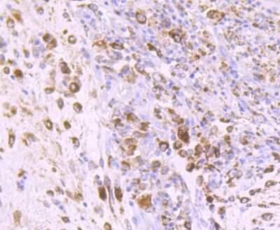 Immunohistochemistry-Paraffin: IGF-II/IGF2 Antibody (JJ092-3) [NBP2-67915] - Analysis of paraffin-embedded human colon cancer tissue using anti-IGF2 antibody. Counter stained with hematoxylin.