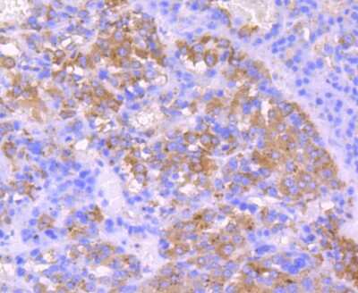 Immunohistochemistry-Paraffin: IGF-II/IGF2 Antibody (JJ092-3) [NBP2-67915] - Analysis of paraffin-embedded human liver cancer tissue using anti-IGF2 antibody. Counter stained with hematoxylin.