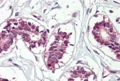 Immunohistochemistry-Paraffin: IGF2BP1 Antibody [NBP1-52044] - 3.75ug/ml staining of paraffin embedded Human Breast. Steamed antigen retrieval with citrate buffer pH 6, AP-staining.