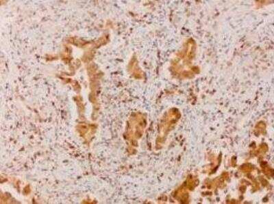 Immunohistochemistry-Paraffin: IGF2BP1 Antibody [NBP1-57495] - Human lung adenocarcinoma.