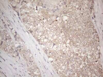 Immunohistochemistry: IGFBP-1 Antibody (OTI6C7) - Azide and BSA Free [NBP2-71011] - Analysis of Adenocarcinoma of Human endometrium tissue. (Heat-induced epitope retrieval by 1mM EDTA in 10mM Tris buffer (pH8.5) at 120C for 3 min)