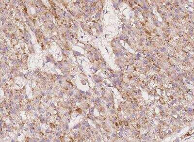 Immunohistochemistry-Paraffin: IGHMBP2 Antibody [NBP3-06533] - Staining of human IGHMBP2 in human hepatoma with rabbit polyclonal antibody at 1:300 dilution.