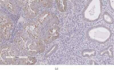 Immunohistochemistry: IGSF9 Antibody [NBP1-93676] - Expression of IGSF9 in normal endometrium and endometrial carcinoma. IHC staining of IGSF9, the right half is noncancerous endometrial glands with weak brown stain, while the left side cancer cells stained strongly brown indicating higher level of expression. Image collected and cropped by CiteAb from the following publication (//www.hindawi.com/journals/jo/2018/2439527/), licensed under a CC-BY license.