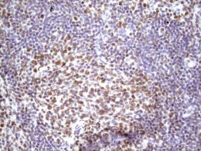 Immunohistochemistry: IKK epsilon/IKBKE Antibody (3C5) [NBP2-46047] - Analysis of Carcinoma of Human lung tissue. (Heat-induced epitope retrieval by 1 mM EDTA in 10mM Tris, pH8.5, 120C for 3min)