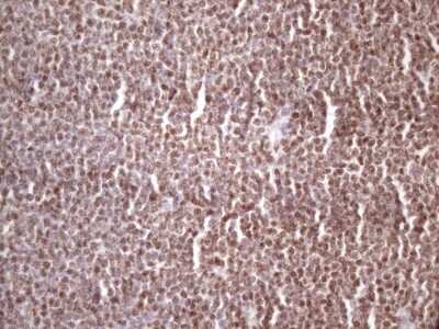 Immunohistochemistry: IKK epsilon/IKBKE Antibody (3C5) [NBP2-46047] - Analysis of Human lymphoma tissue. (Heat-induced epitope retrieval by 1 mM EDTA in 10mM Tris, pH8.5, 120C for 3min)