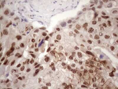 Immunohistochemistry: IKK epsilon/IKBKE Antibody (OTI3C5) - Azide and BSA Free [NBP2-71490] - Analysis of Adenocarcinoma of Human breast tissue. (Heat-induced epitope retrieval by 1 mM EDTA in 10mM Tris, pH8.5, 120C for 3min)