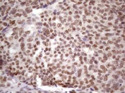 Immunohistochemistry: IKK epsilon/IKBKE Antibody (OTI3C5) - Azide and BSA Free [NBP2-71490] - Analysis of Adenocarcinoma of Human ovary tissue. (Heat-induced epitope retrieval by 1 mM EDTA in 10mM Tris, pH8.5, 120C for 3min)