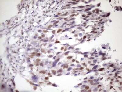 Immunohistochemistry: IKK epsilon/IKBKE Antibody (OTI3C5) - Azide and BSA Free [NBP2-71490] - Analysis of Carcinoma of Human kidney tissue. (Heat-induced epitope retrieval by 1 mM EDTA in 10mM Tris, pH8.5, 120C for 3min)