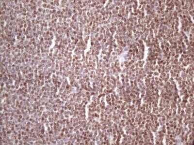 Immunohistochemistry: IKK epsilon/IKBKE Antibody (OTI3C5) - Azide and BSA Free [NBP2-71490] - Analysis of Human lymphoma tissue. (Heat-induced epitope retrieval by 1 mM EDTA in 10mM Tris, pH8.5, 120C for 3min)