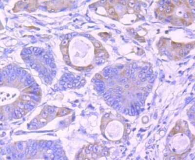 Immunohistochemistry-Paraffin: IKK gamma Antibody (JA11-83) [NBP2-66904] - Analysis of paraffin-embedded human colon cancer tissue using anti-IKK gamma antibody. Counter stained with hematoxylin.