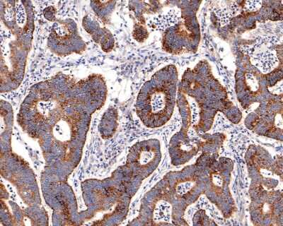 Immunohistochemistry-Paraffin: IKK gamma Antibody (JA11-83) [NBP2-66904] - Analysis of paraffin-embedded human colon carcinoma tissue with Rabbit anti-IKK gamma antibody washed with ddH2O and PBS, and then probed with the primary antibody  at 1/400 dilution for 1 hour at room temperature. The detection was performed using an HRP conjugated compact polymer system. DAB was used as the chromogen. Tissues were counterstained with hematoxylin and mounted with DPX.