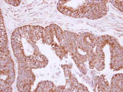 Immunohistochemistry-Paraffin: IL-1 alpha/IL-1F1 Antibody [NBP2-16939] -  Human colon carcinoma, using IL1 alpha antibody at 1:250 dilution. Antigen Retrieval: Trilogy™ (EDTA based, pH 8.0) buffer, 15min.
