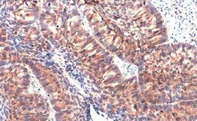 Immunohistochemistry-Paraffin: IL-1 alpha/IL-1F1 Antibody [NBP2-16939] -  Human cervical carcinoma. IL1 alpha stained by IL1 alpha antibody diluted at 1:500.Antigen Retrieval: Citrate buffer, pH 6.0, 15 min. 