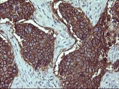 Immunohistochemistry: IL-1 alpha/IL-1F1 Antibody (OTI2F8) - Azide and BSA Free [NBP2-71021] - Analysis of Carcinoma of Human lung tissue.(Heat-induced epitope retrieval by 10mM citric buffer, pH6.0, 120C for 3min)