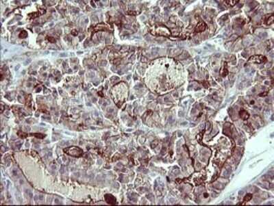 Immunohistochemistry: IL-1 alpha/IL-1F1 Antibody (OTI2F8) - Azide and BSA Free [NBP2-71021] - Analysis of Carcinoma of Human thyroid tissue. (Heat-induced epitope retrieval by 10mM citric buffer, pH6.0, 120C for 3min)