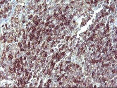 Immunohistochemistry: IL-10R alpha Antibody (OTI1D10) - Azide and BSA Free [NBP2-71030] - Analysis of Human lymphoma tissue. (Heat-induced epitope retrieval by 10mM citric buffer, pH6.0, 120C for 3min)