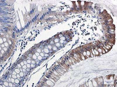 Immunohistochemistry-Paraffin: IL-18/IL-1F4 Antibody (S02-8B2) [NBP3-20042] - Immunohistochemistry of IL-18/IL-1F4 in paraffin-embedded Human colon cancer tissue using NBP3-20042 at dilution 1/50