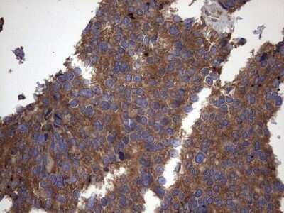 Immunohistochemistry: IL-1ra/IL-1F3/IL1RN Antibody (OTI2B1) - Azide and BSA Free [NBP2-71022] - Analysis of Adenocarcinoma of Human breast tissue. (Heat-induced epitope retrieval by 1 mM EDTA in 10mM Tris, pH8.5, 120C for 3min)