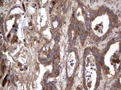 Immunohistochemistry: IL-1ra/IL-1F3/IL1RN Antibody (OTI2B1) - Azide and BSA Free [NBP2-71022] - Analysis of Adenocarcinoma of Human colon tissue. (Heat-induced epitope retrieval by 1 mM EDTA in 10mM Tris, pH8.5, 120C for 3min)