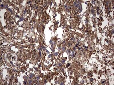 Immunohistochemistry: IL-1ra/IL-1F3/IL1RN Antibody (OTI2B1) - Azide and BSA Free [NBP2-71022] - Analysis of Adenocarcinoma of Human ovary tissue. (Heat-induced epitope retrieval by 1 mM EDTA in 10mM Tris, pH8.5, 120C for 3min)