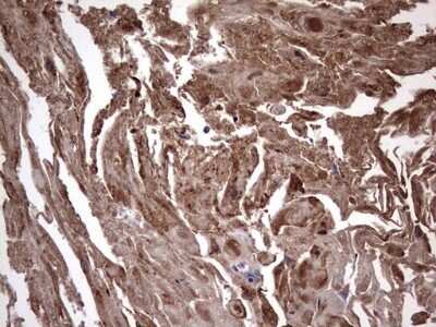 Immunohistochemistry: IL-1ra/IL-1F3/IL1RN Antibody (OTI2B1) - Azide and BSA Free [NBP2-71022] - Analysis of Carcinoma of Human bladder tissue. (Heat-induced epitope retrieval by 1 mM EDTA in 10mM Tris, pH8.5, 120C for 3min)
