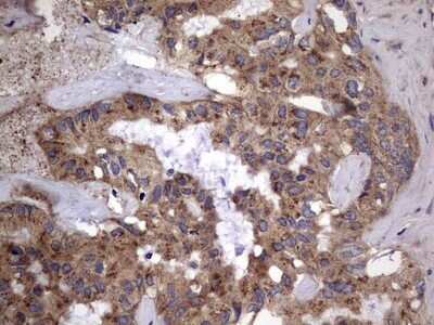 Immunohistochemistry: IL-1ra/IL-1F3/IL1RN Antibody (OTI2B1) - Azide and BSA Free [NBP2-71022] - Analysis of Carcinoma of Human liver tissue.(Heat-induced epitope retrieval by 1 mM EDTA in 10mM Tris, pH8.5, 120C for 3min)