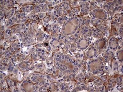 Immunohistochemistry: IL-1ra/IL-1F3/IL1RN Antibody (OTI2B1) - Azide and BSA Free [NBP2-71022] - Analysis of Carcinoma of Human thyroid tissue. (Heat-induced epitope retrieval by 1 mM EDTA in 10mM Tris, pH8.5, 120C for 3min)