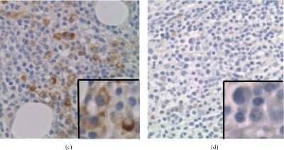 Immunohistochemistry: IL-21R Antibody [NBP1-87502] - FISH analysis of BM aspirates using the A20/BLIMP1/SHGC-79576 Three Color Probe (Cancer Genetics Italia(TM)) and IL21R staining of a BM biopsied specimen. Green, red, and yellow signals represent BLIMP1, A20, and SHGC-79576, respectively. (c) >70% positivity of IL-21R in lymphoplasmacytic cells and plasma cells (original magnification x600). (d) <30% positivity of IL-21R in lymphoplasmacytic cells and plasma cells (original magnification x600). Image collected and cropped by CiteAb from the following publication (//www.hindawi.com/journals/bmri/2018/6728128/), licensed under a CC-BY license.