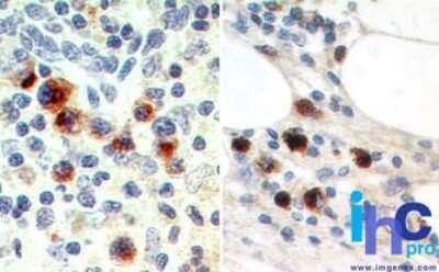 Immunohistochemistry-Paraffin: IL-27/IL-35 EBI3 Subunit Antibody (15k8D10) - Azide Free [NBP2-27363] - Formalin-fixed, paraffin-embedded human spleen (left) and lymph node metastatic malignant melanoma (right) stained with IL-35 antibody (5 ug/ml) using peroxidase-conjugate and DAB chromogen.