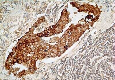 Immunohistochemistry: IL-27R alpha/WSX-1/TCCR Antibody (34N4G11) - Azide and BSA Free [NBP2-80807] - Adenocarcinoma of the stomach probed with IL-27R antibody at 5 ug/ml. Image from the standard format of this antibody.