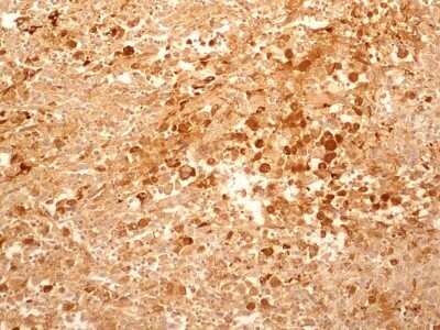 Immunohistochemistry: IL-27R alpha/WSX-1/TCCR Antibody (34N4G11) - Azide and BSA Free [NBP2-80807] - IHC-P detection of IL27RA protein in a section of human renal/kidney cancer tissue using IL27RA antibody (34N4G11) at a concentration of 5ug/ml. The representative image shows membrane-cytoplasmic positivity for IL27RA protein in the cancer cells. Image f