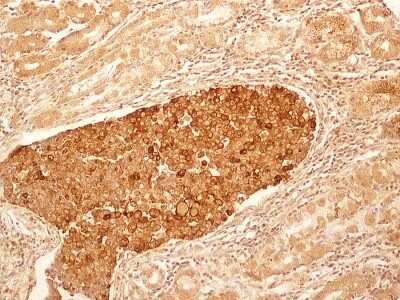 Immunohistochemistry: IL-27R alpha/WSX-1/TCCR Antibody (34N4G11) - Azide and BSA Free [NBP2-80807] - IHC-P detection of IL27RA protein in a section of human stomach cancer tissue using IL27RA antibody (34N4G11) at a concentration of 5ug/ml. The cancer cells showed intense membrane-cytoplasmic positivity for IL27RA protein, whereas, the glands in adjacent