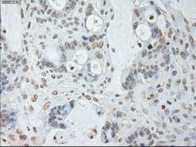 Immunohistochemistry-Paraffin: IL-6 Antibody (3G9) [NBP1-47810] -  Staining of paraffin-embedded Adenocarcinoma of Human colon tissue using anti-IL6 mouse monoclonal antibody.