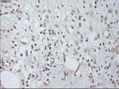 Immunohistochemistry-Paraffin: IL-6 Antibody (3G9) [NBP1-47810] -  Staining of paraffin-embedded Carcinoma of Human pancreas tissue using anti-IL6 mouse monoclonal antibody.