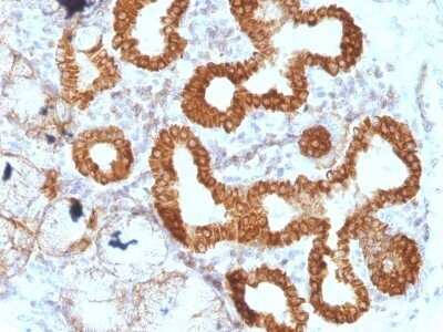 Immunohistochemistry-Paraffin: IL-6 Antibody (IL6/1270) - Azide and BSA Free [NBP2-47987] - Human Esophageal Carcinoma stained with IL-6 Monoclonal Antibody (IL6/1270).