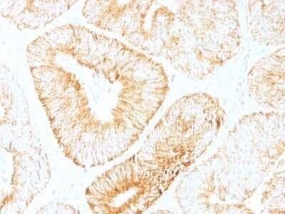 Immunohistochemistry-Paraffin: IL-6 Antibody (IL6/1270) - Azide and BSA Free [NBP2-47987] - Human Colon Carcinoma stained with IL-6 Monoclonal Antibody (IL6/1270).