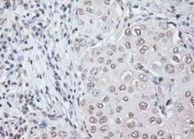 Immunohistochemistry-Paraffin: IL-6 Antibody (OTI3G9) - Azide and BSA Free [NBP2-71027] - Staining of Adenocarcinoma of Human breast tissue using anti-IL-6 mouse monoclonal antibody. (Heat-induced epitope retrieval by 10mM citric buffer, pH6.0, 100 degrees C for 10min.