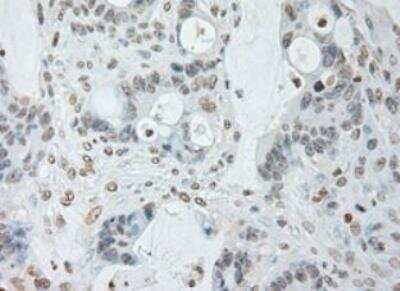 Immunohistochemistry-Paraffin: IL-6 Antibody (OTI3G9) - Azide and BSA Free [NBP2-71027] - Staining of  Adenocarcinoma of Human colon tissue using anti-IL-6 mouse monoclonal antibody. (Heat-induced epitope retrieval by 10mM citric buffer, pH6.0, 100 degrees C for 10min.