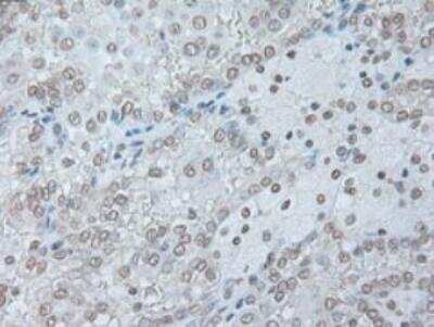 Immunohistochemistry-Paraffin: IL-6 Antibody (OTI3G9) - Azide and BSA Free [NBP2-71027] - Staining of Carcinoma of Human kidney tissue using anti-IL-6 mouse monoclonal antibody. (Heat-induced epitope retrieval by 10mM citric buffer, pH6.0, 100 degrees C for 10min.